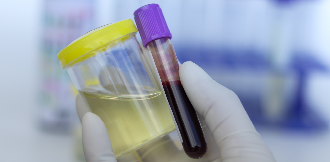 Comparing Blood Drug Tests vs. Urine Drug Tests