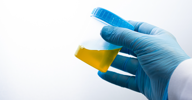 Doctor holding a urine sample in a bottle